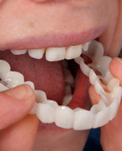 Snap-On Veneers