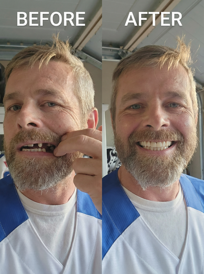Acrylic Partial Denture