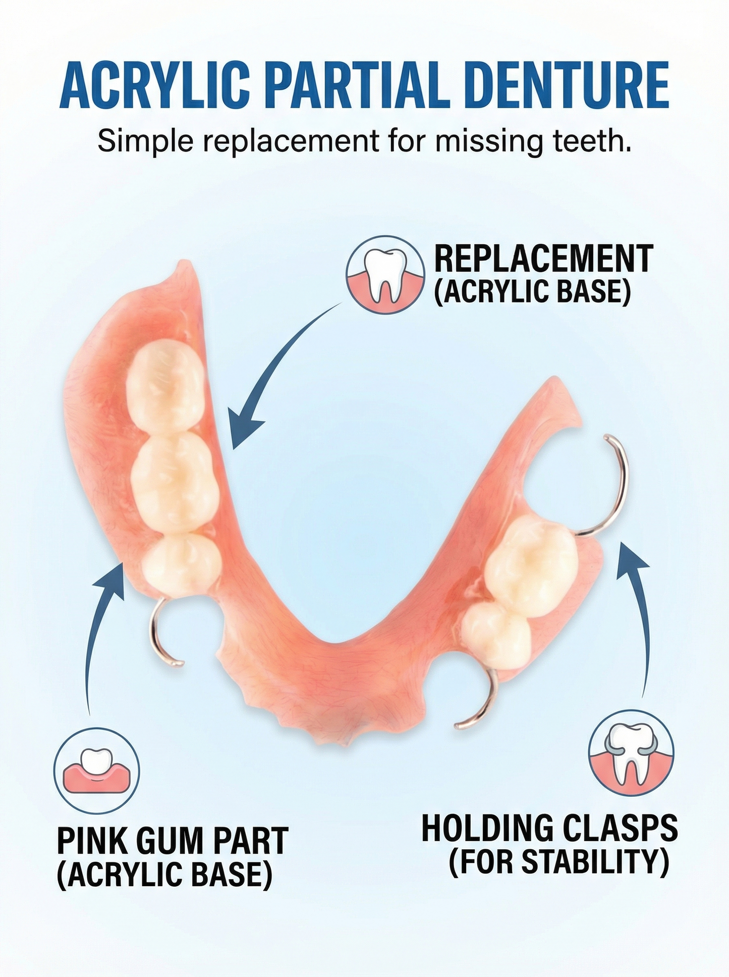Diagram of an acrylic partial denture with labeled parts on a light blue background.
