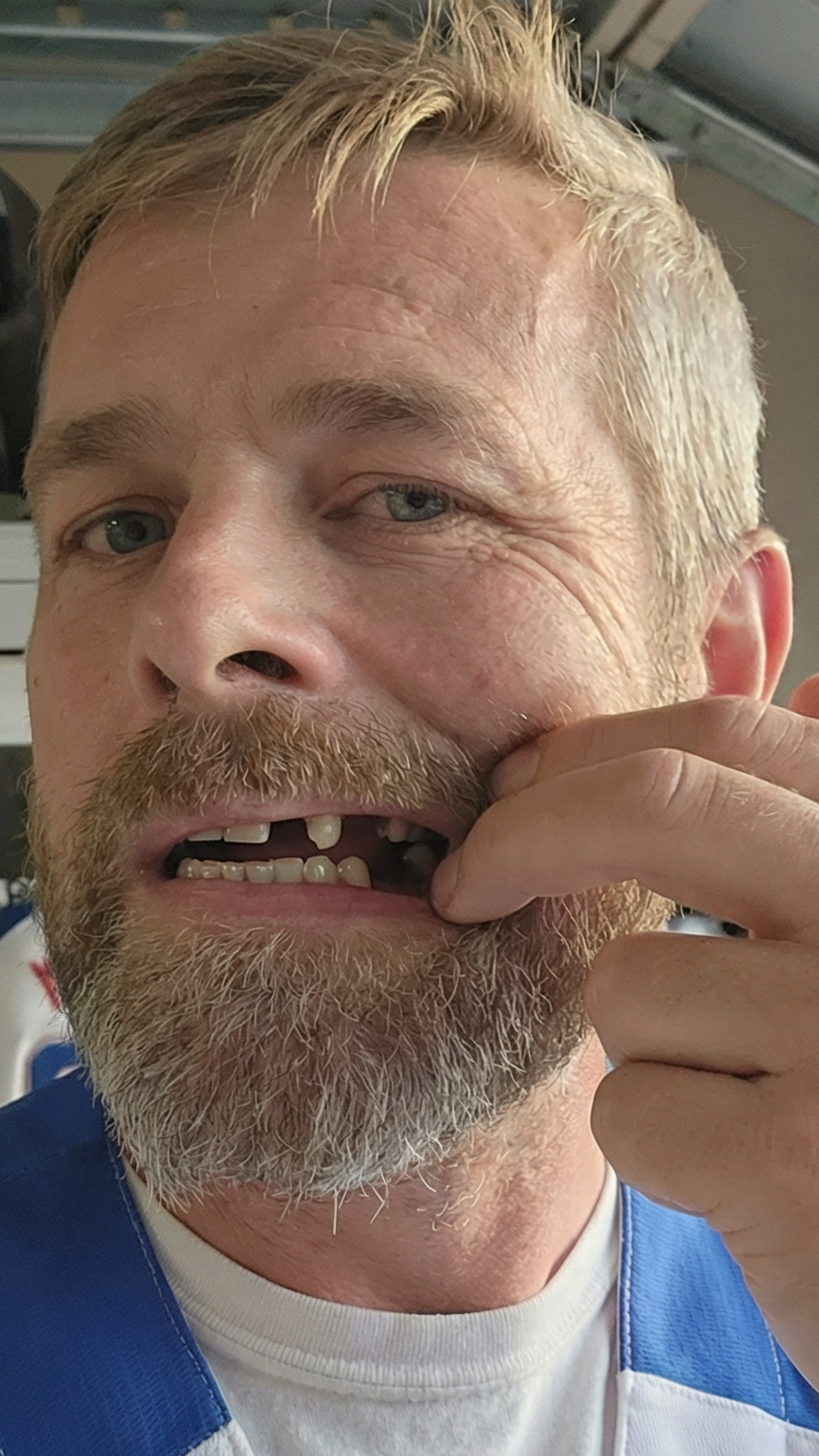 Before and after comparison of a man with dental issues and a healthy smile.