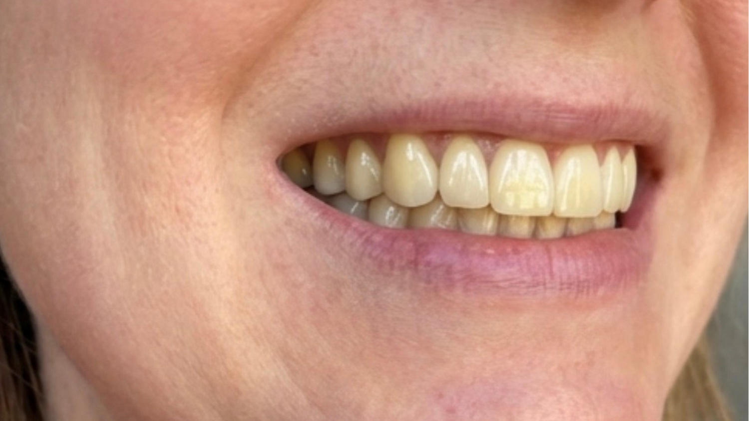 Close-up of a person's mouth showing natural-looking yellowish-white teeth, with part of the nose, lips, cheek, and hair visible.