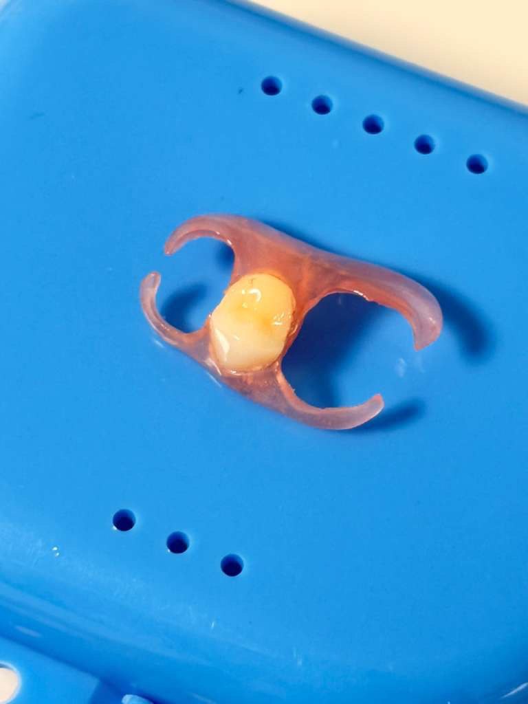 Dental Flipper tooth on a blue surface