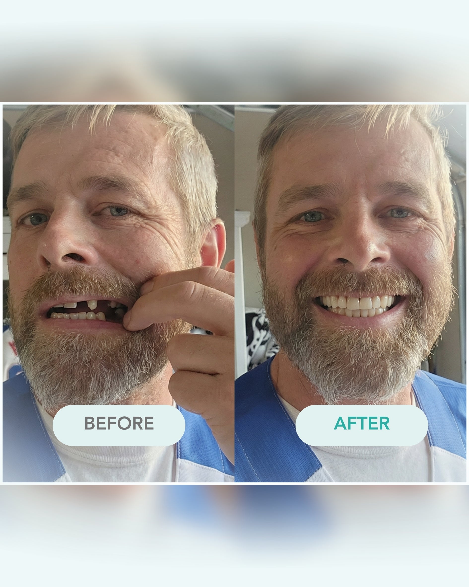 Before and after comparison of a man with with partial dentures, showing a smile.