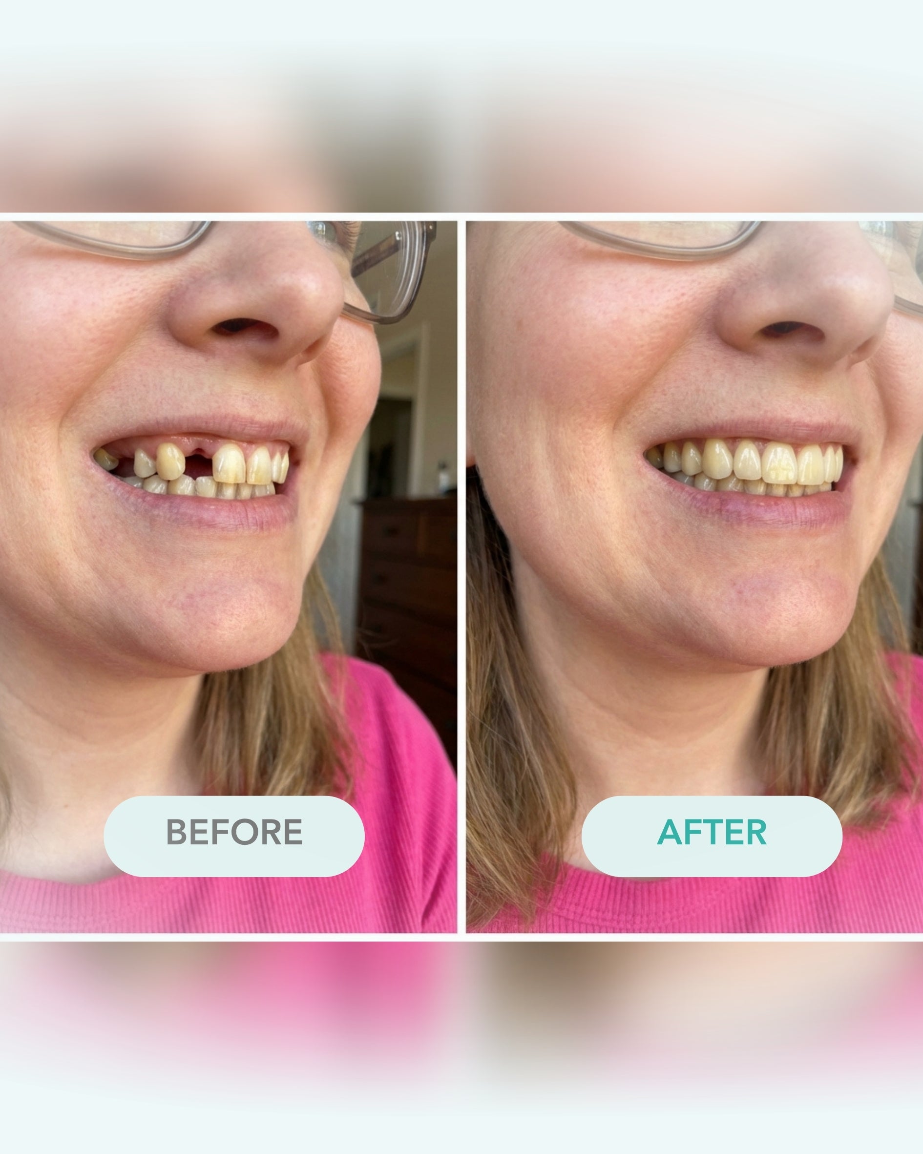 Before and after comparison of a person with missing teeth, wearing glasses, and a pink shirt.