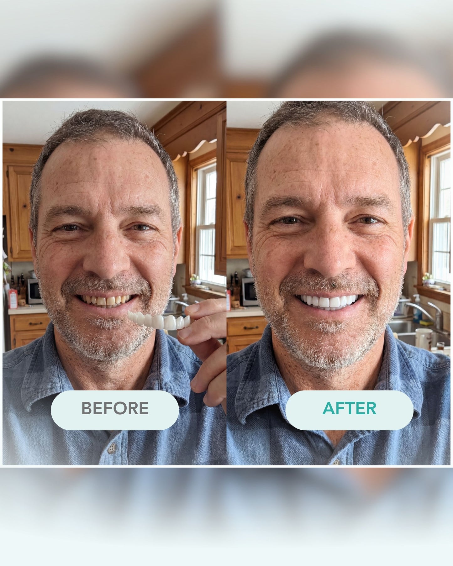 Snap-On Veneers